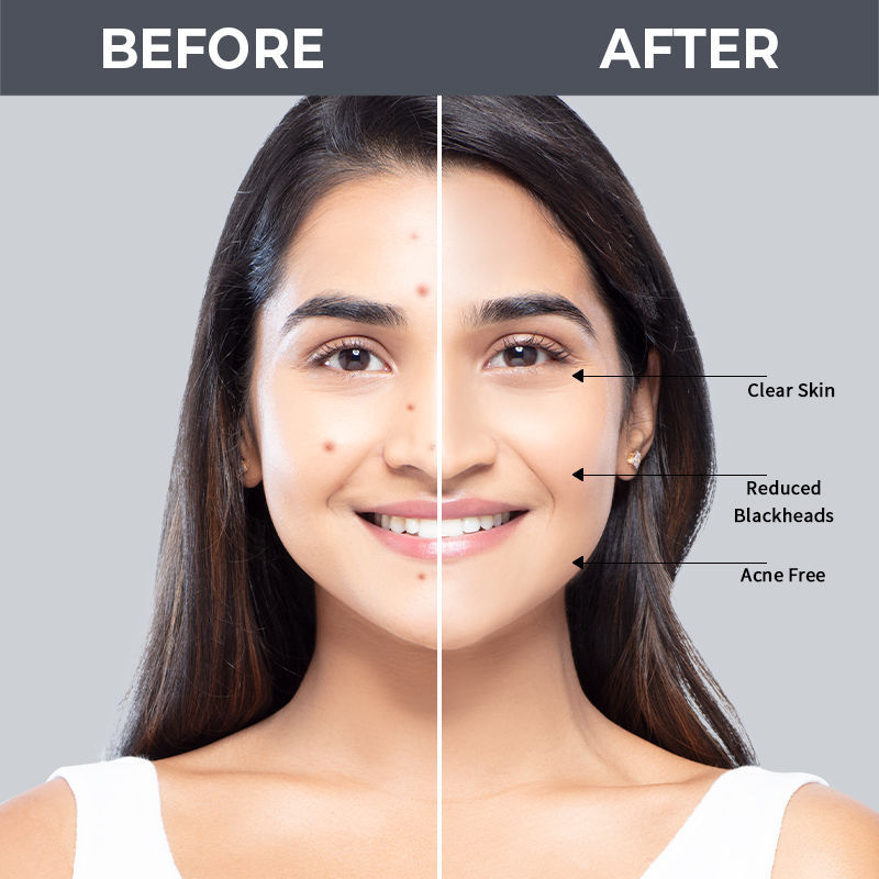 Nykaa SKINRX 2% Salicylic Acid Face Serum For Acne, Blackheads, Whiteheads & Clear Skin