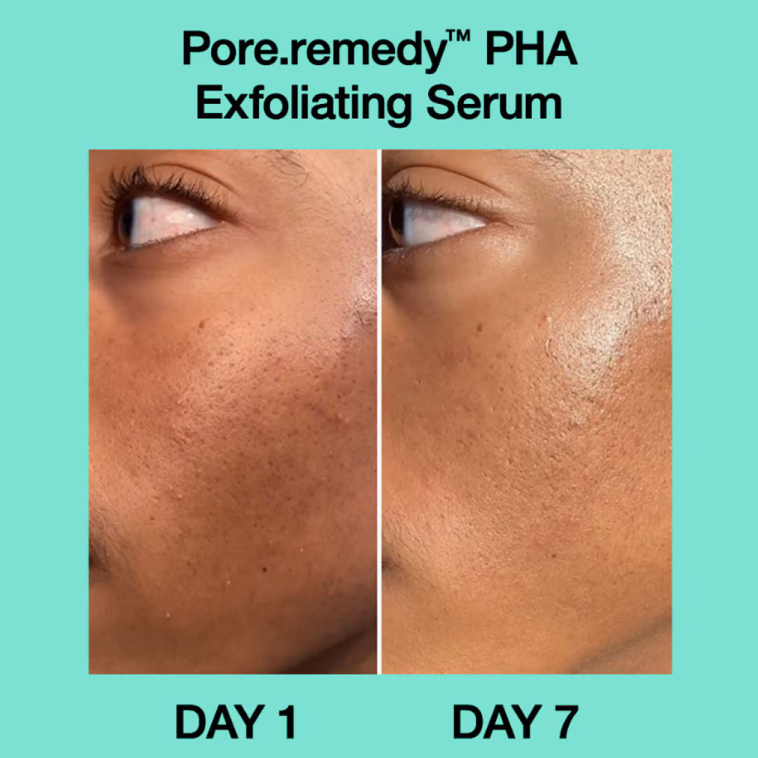 Pore Remedy Pha Exfoliating Serum – Gentle Smoothing Serum For Blackheads & Oil Control