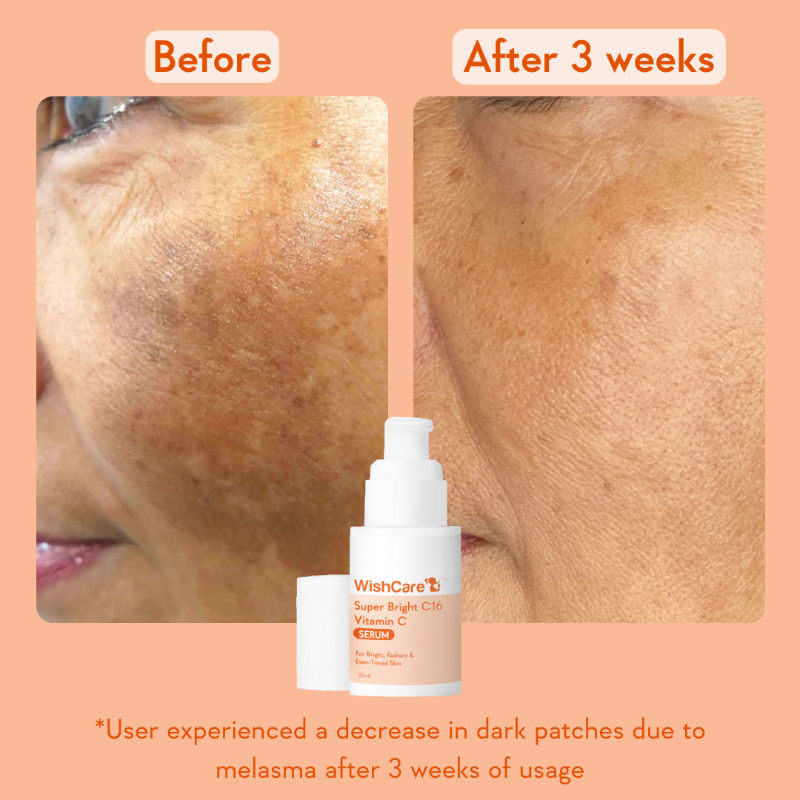 Super Bright C16 Vitamin C Face Serum for Glowing Skin- Reduces Pigmentation & Dark Spots