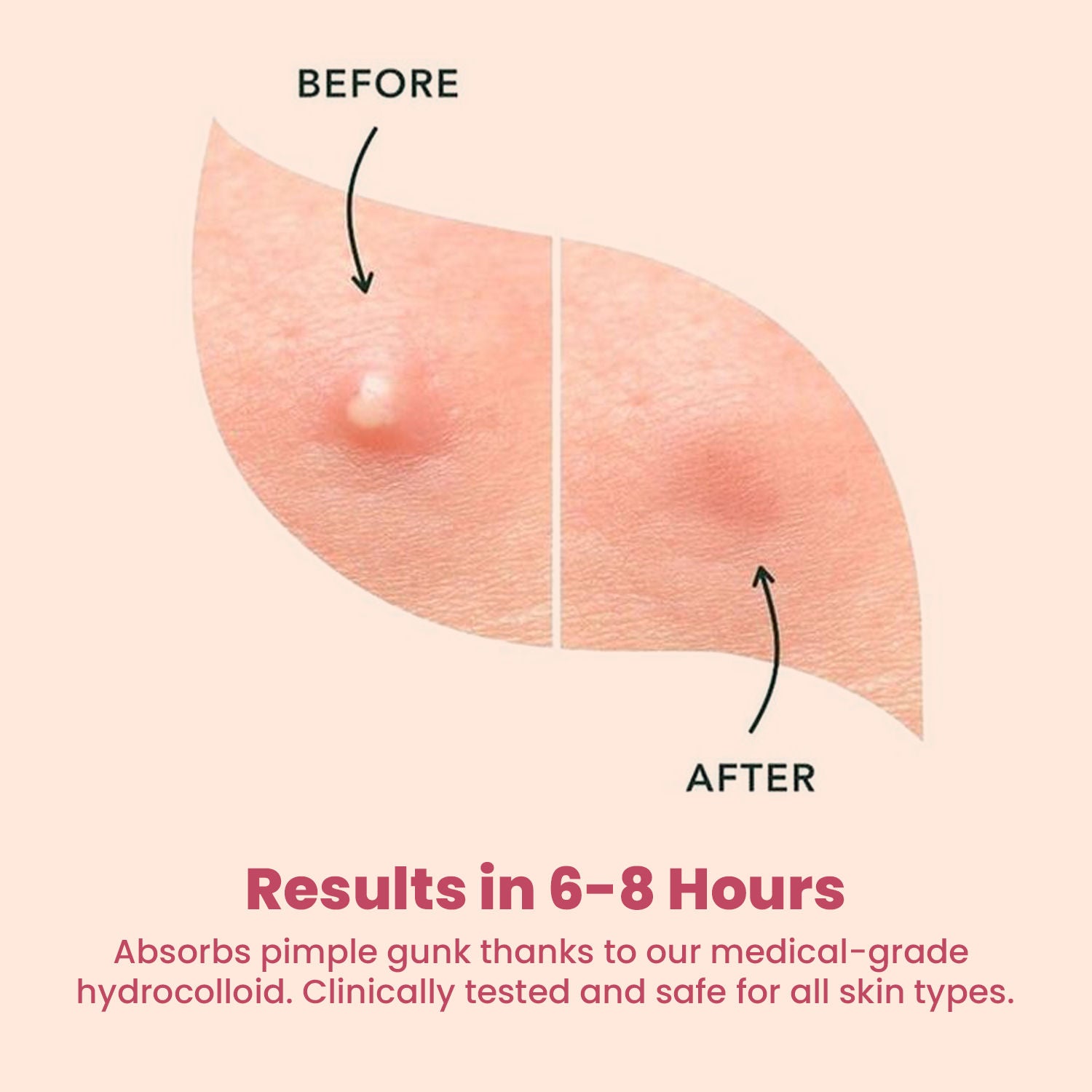 Acne Pimple Patches