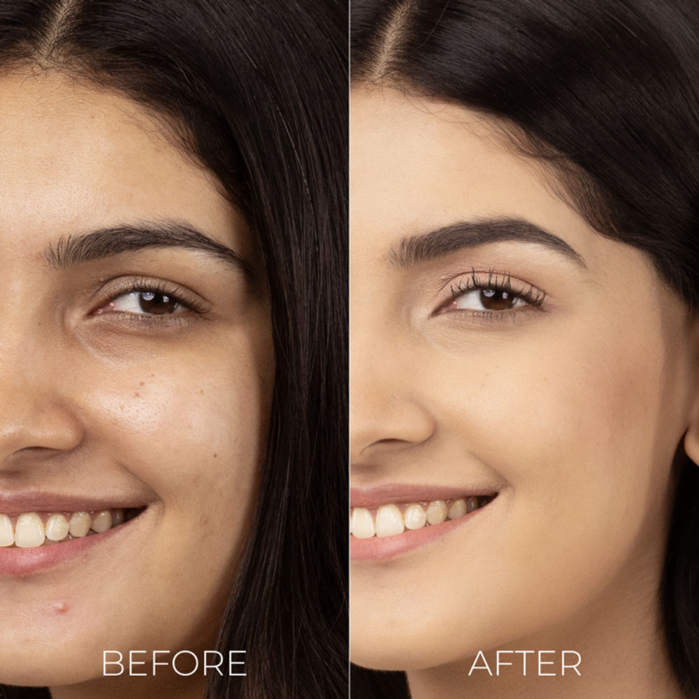 Salicylic Acid Liquid Moisturizer for Oily & Acne Prone Skin Visible Acne Reduction in 1 Week