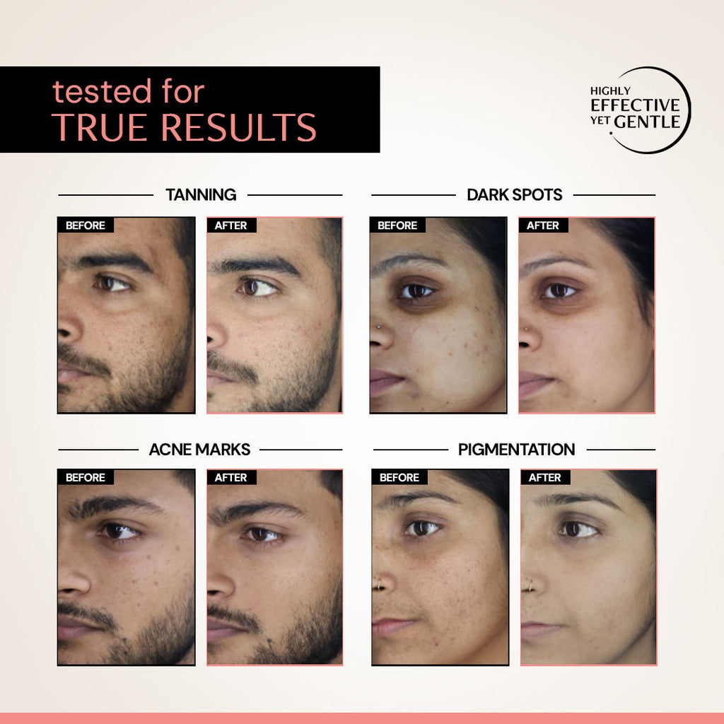 5% Niacinamide Face Serum with Alpha Arbutin, For Acne Marks, Beginner Friendly