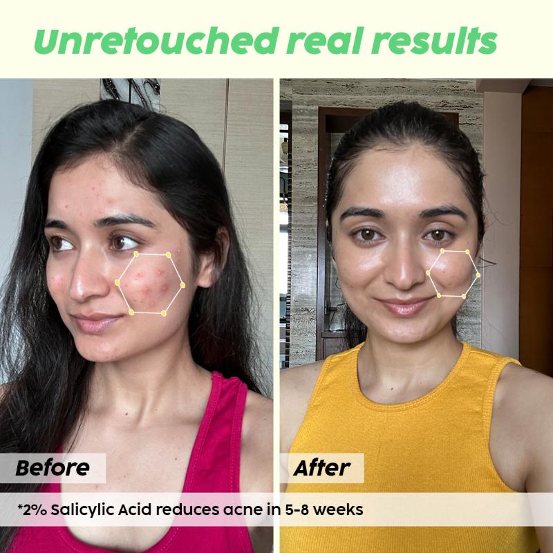 2% Salicylic Acid Acne Spot Corrector Gel For Reducing Active Acne, Controls Oil and Acne Scars