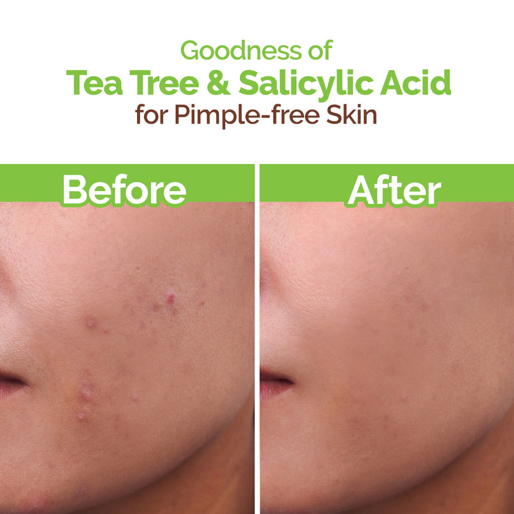 Face Wash With Tea Tree Oil And Neem Extract For Acne &pimples