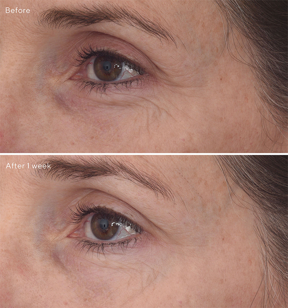 Retinal Resculpt Eye Treatment