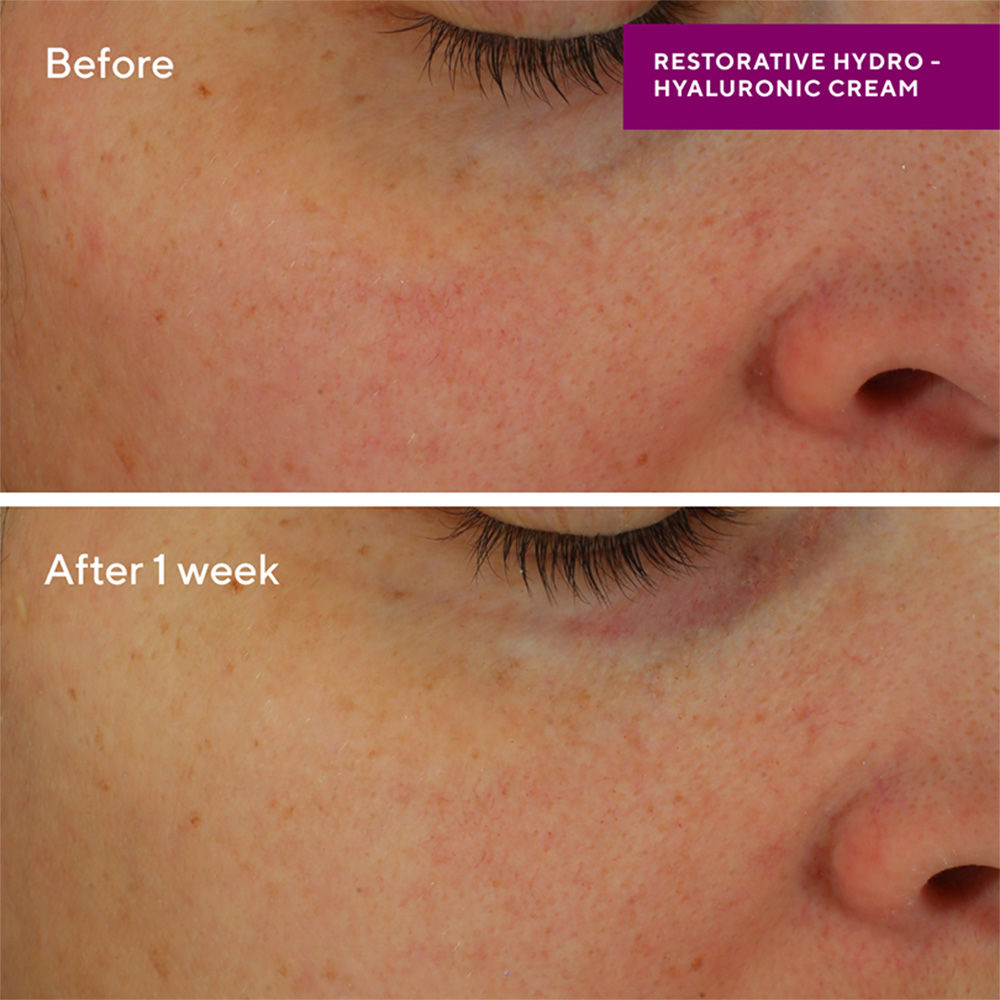 Restorative Hydro-Hyaluronic Cream