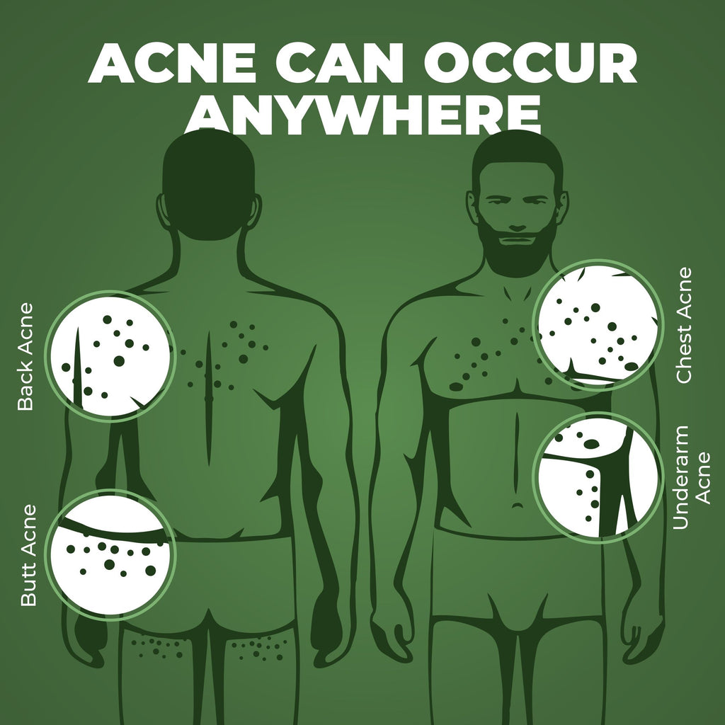 B-Acne Clear Bodywash