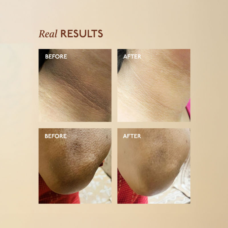 Pigmentation Removal Cream for Dark Neck & Knees, Elbows for Men & Women