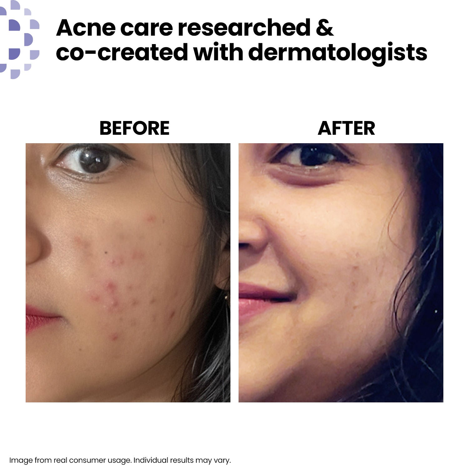 Acne Care Purifying Cleanser Salicylic Acid Face Wash Reduces Acne & Pimples for Pimple Prone Skin Face Wash for Oily Skin, 100ml