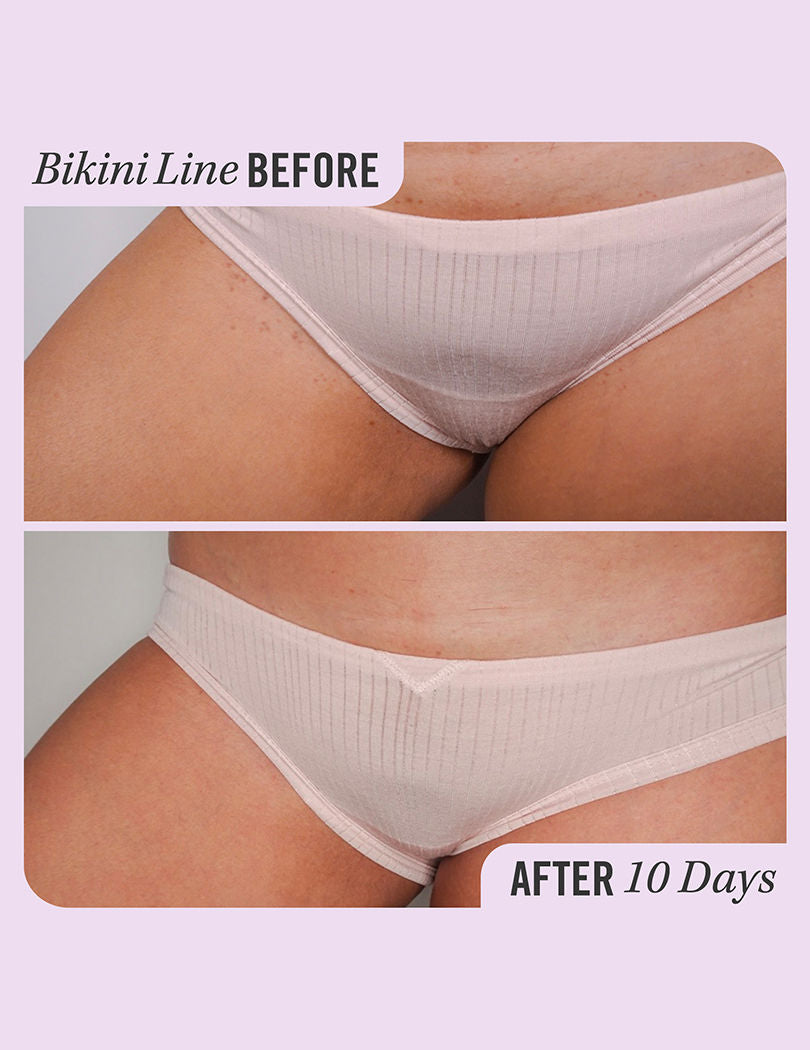 Ingrown Hair Treatment Pads