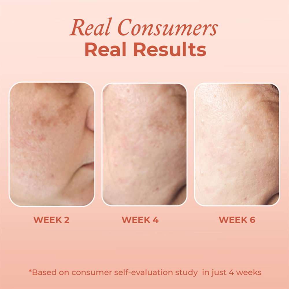 Dark Spot & Hyperpigmentation Face Serum