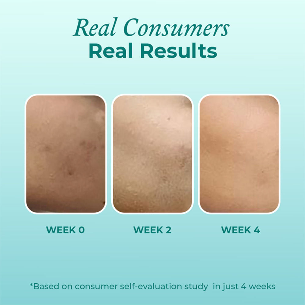 12% Niacinamide Serum - Evens Skin Texture, Controls Excess Oil & Refines Pores
