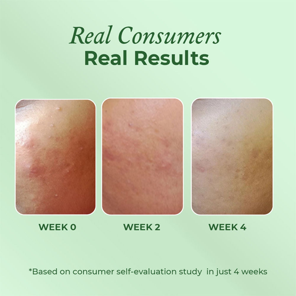 Acne Moisturiser 2% Squalane & 3% Niacinamide Oil Free Hydration & Acne Prevention