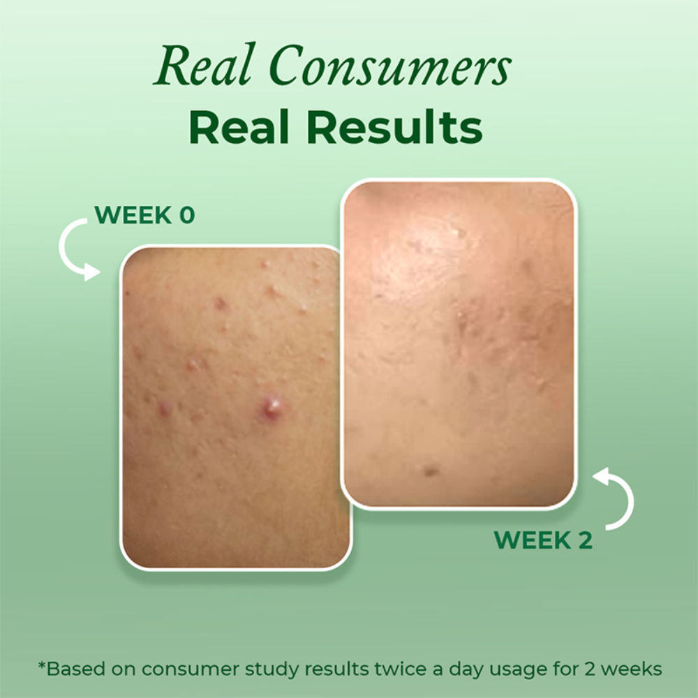 Salicylic Acid Acne Face Wash With Zinc & Cica - Treats Acne & Reduces Excess Oil