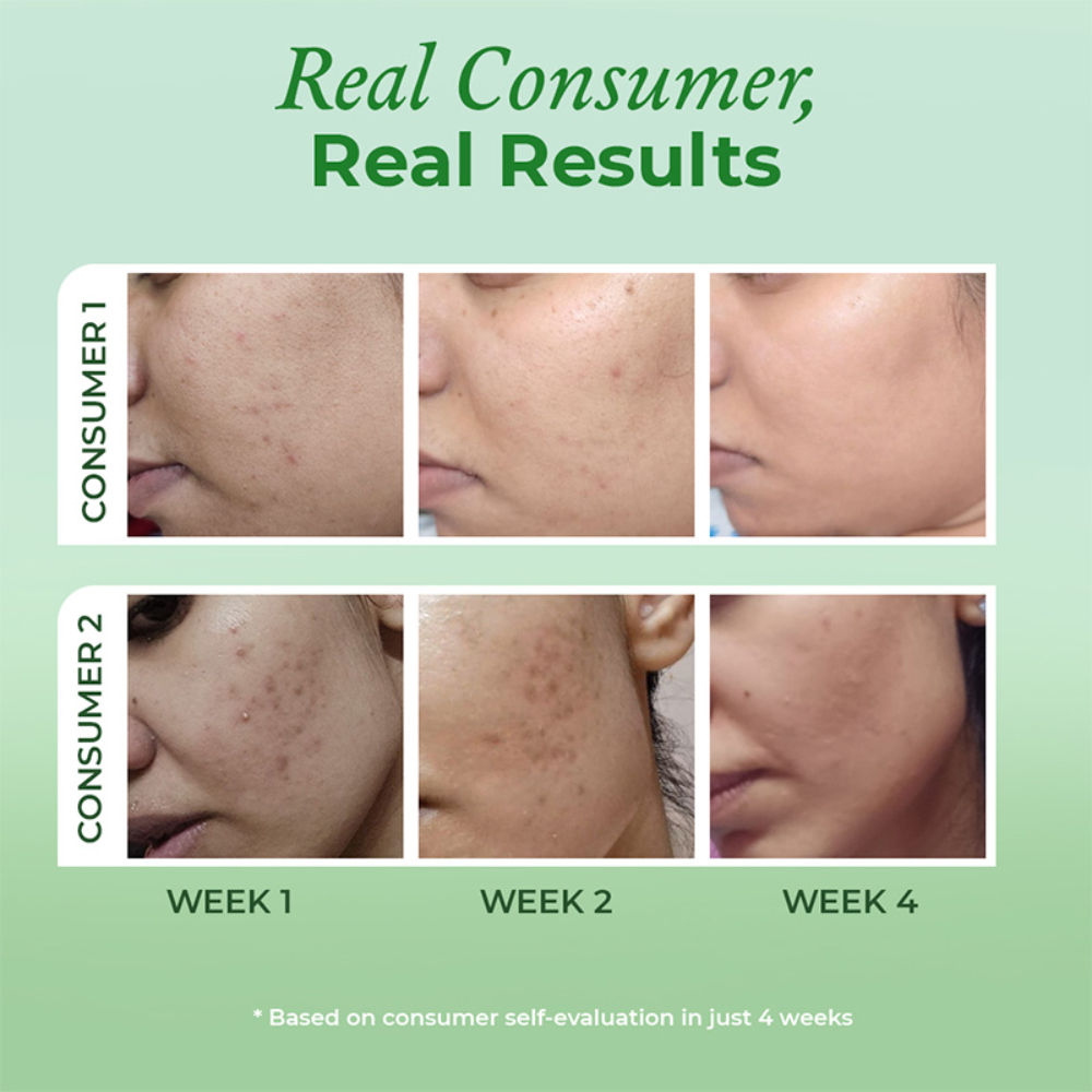 Acne & Oil Control Intense Face Serum with 2% Salicylic Acid