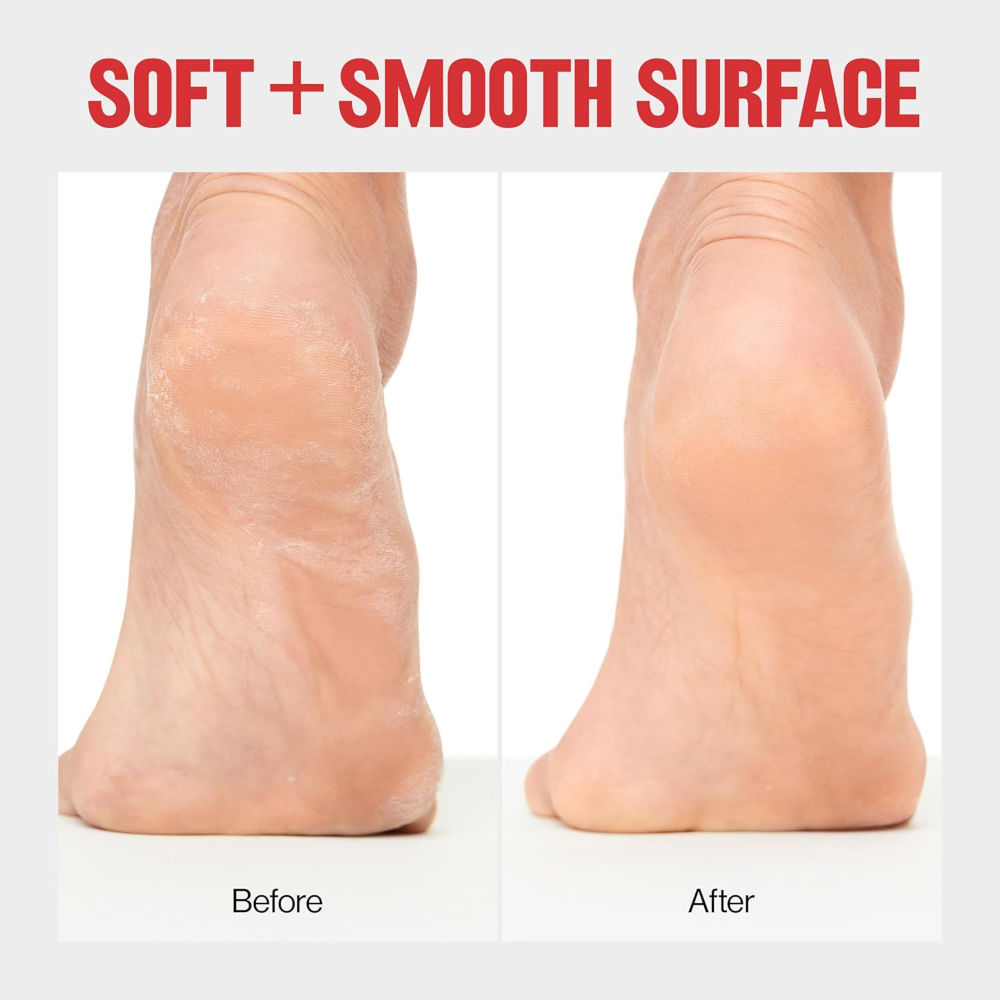 Foot Scrubber For Dead Skin,Pedicure Tools For Feet - Colour May Vary