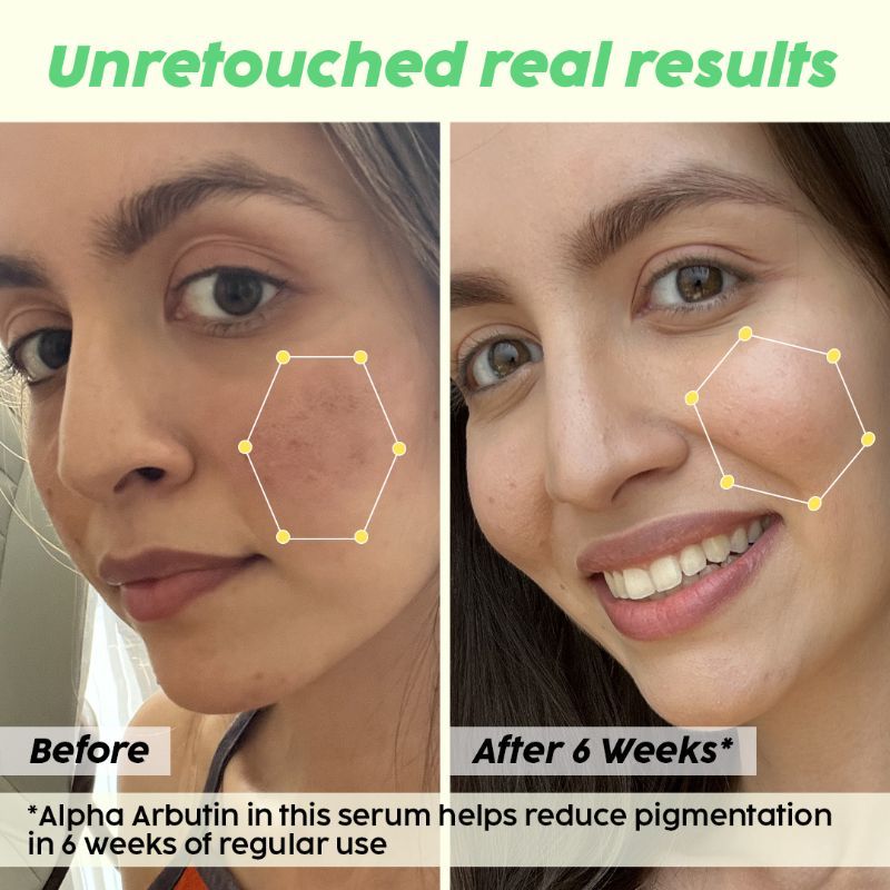2% Alpha Arbutin Pineapple Serum for Pigmentation & Dark Spot Reduction