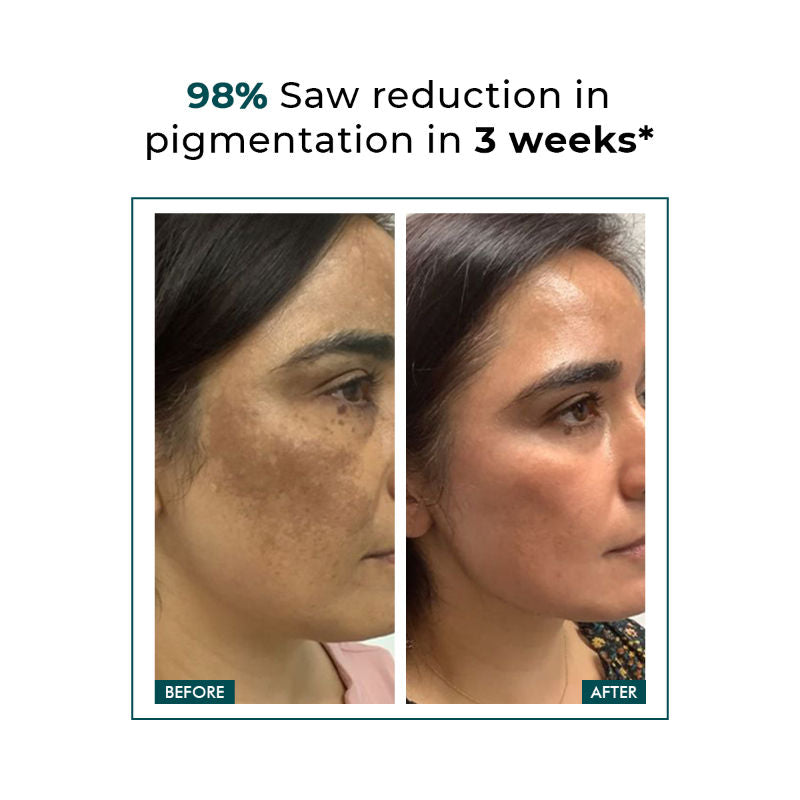 Pigmentation Corrector Cream For Dark Spots Remover & Uneven Skin Tone