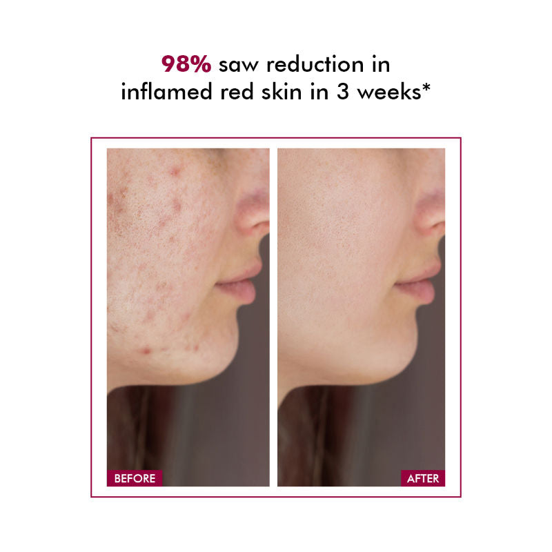 10% Azelaic Acid Gel Cream For Redness Relief & Acne Treatment