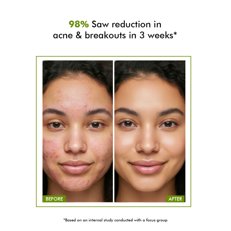 Flashfix Acne Spot Corrector Face Cream With 2% Salicylic Acid & Bio-Actives