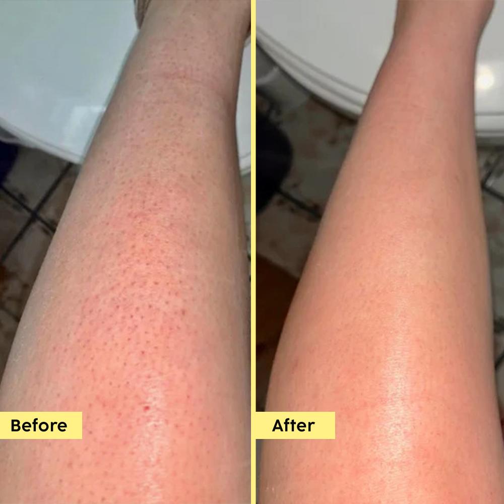 Pineapple 5% Lactic Acid Body Wash Exfoliates Dry, Rough & Strawberry Skin With Deep Cleansing