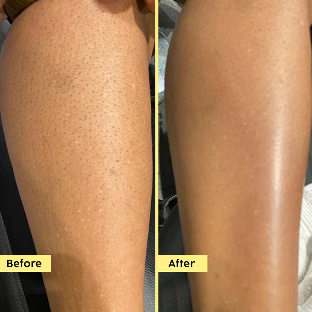 Pineapple 5% Lactic Acid Body Wash Exfoliates Dry, Rough & Strawberry Skin With Deep Cleansing