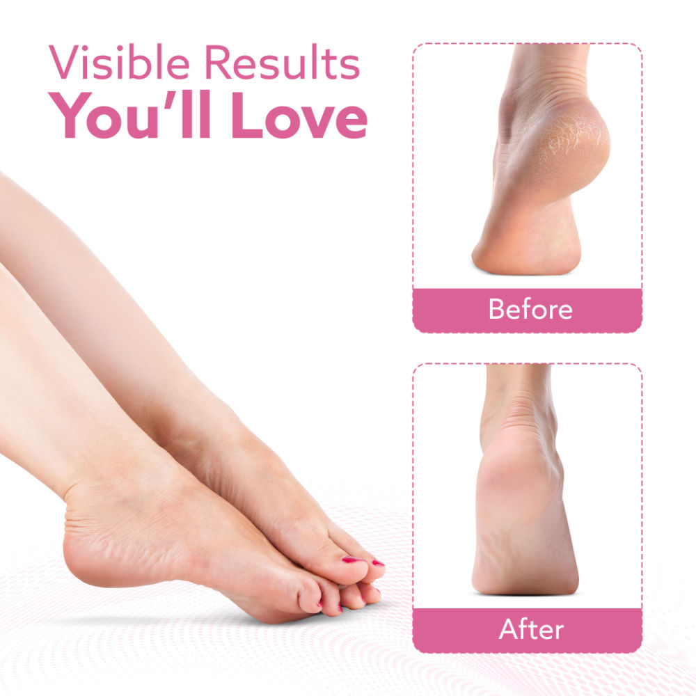 CR1717 Callus Remover Refill Head