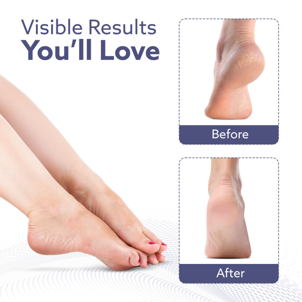CR1414 Callus Remover Refill Head