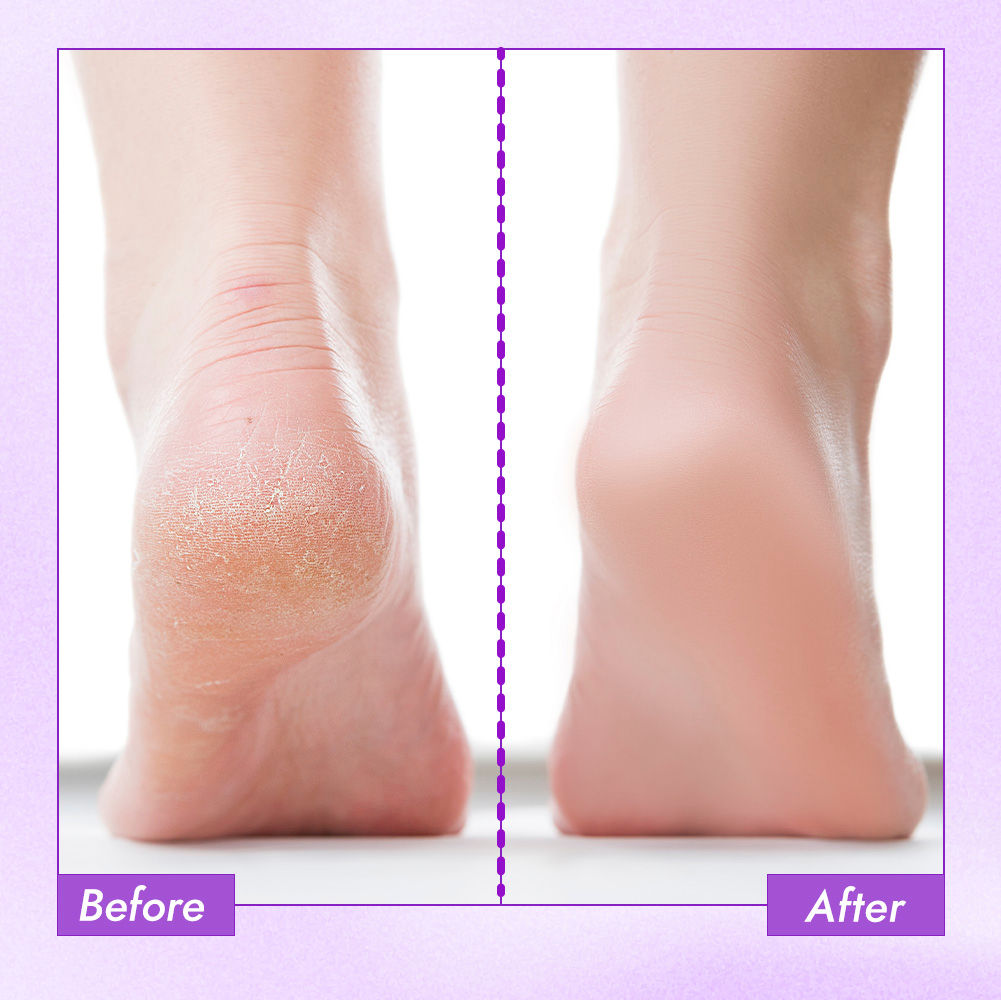 Happy Heels 20%Urea, 2%Lactic Acid Foot Cream-Dry & Cracked Feet