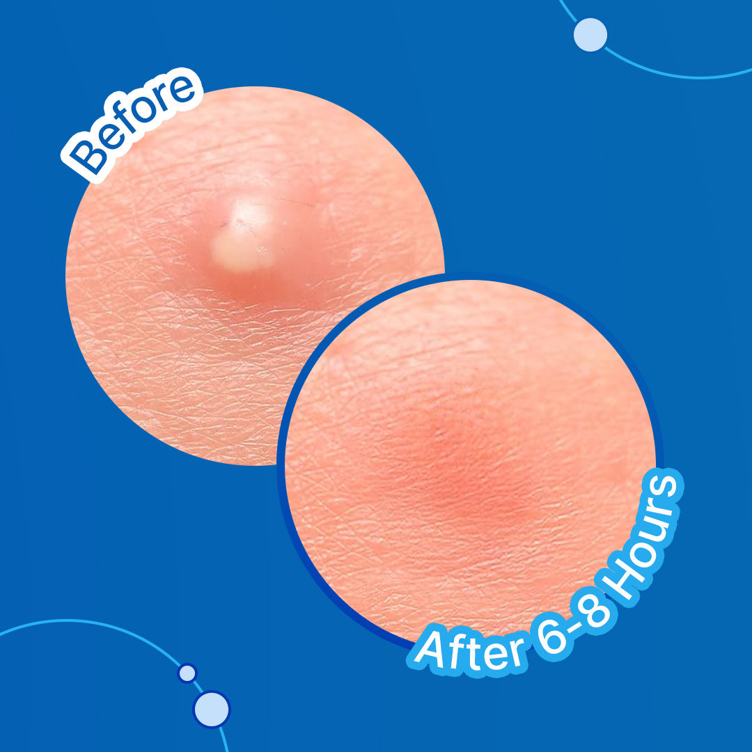 Acne Patches With Salicylic Acid And Hydrocolloid For Clean & Clear Skin - 20 Patches