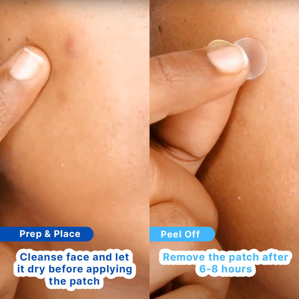 Acne Patches With Salicylic Acid And Hydrocolloid For Clean & Clear Skin - 20 Patches