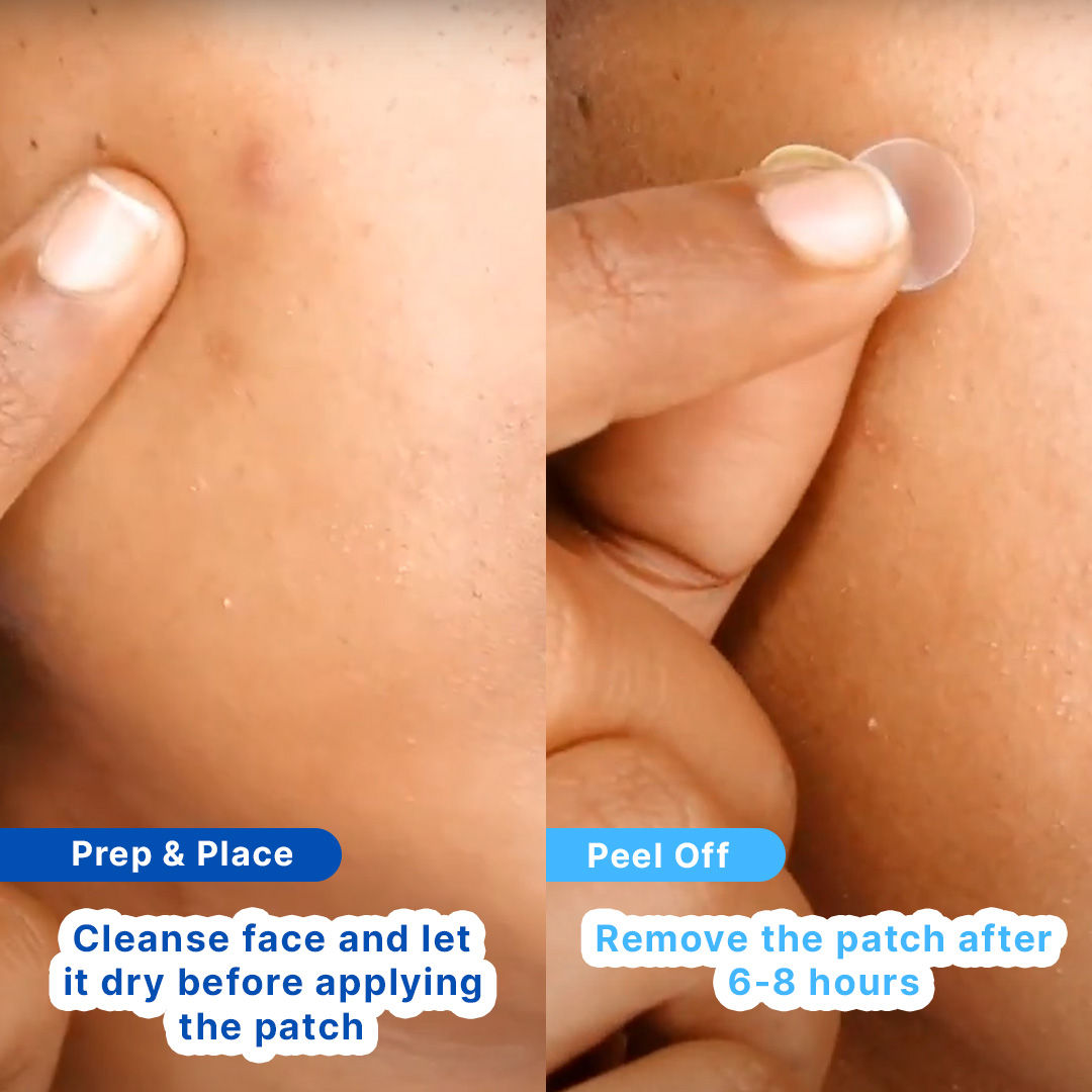 Acne Patches With Salicylic Acid And Hydrocolloid For Clean & Clear Skin - 20 Patches