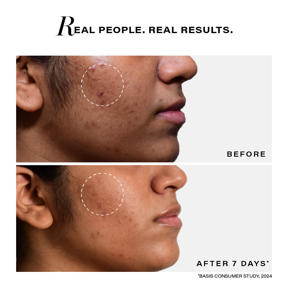 Acne Clearing Serum with Thymol And Terpineol|Non Drying|Non Irritating