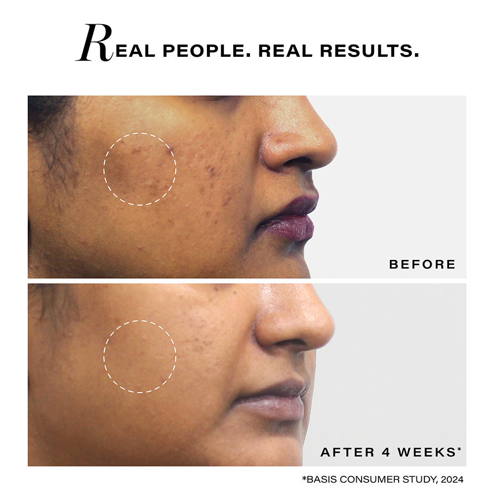 Pigmentation Reduction Moisturiser For Dark Spots, Acne Marks And Uneven Skin Tone