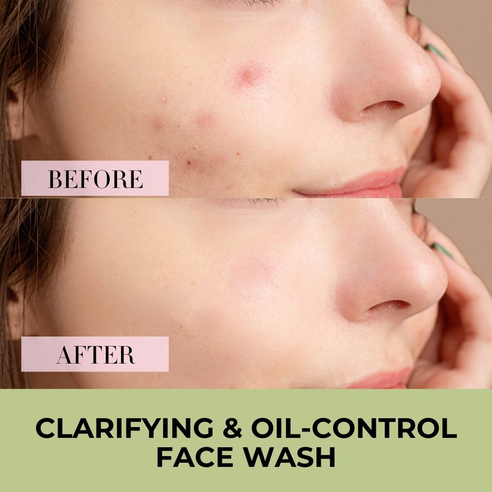Tea Tree, Neem & Aloe Vera Face Wash With Vitamin E For Acne & Oil Control Unisex