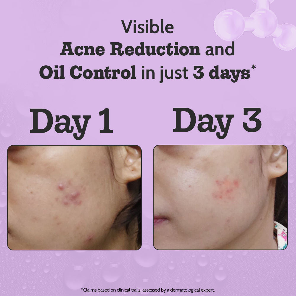 2% Salicylic Acid Face Serum Treats Active Acne, Controls Excess Oil