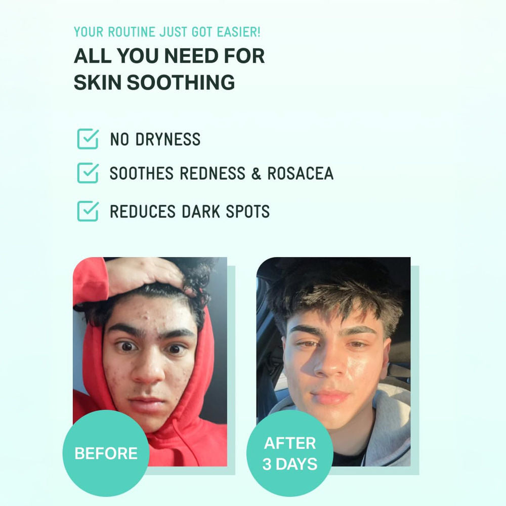 Zinc Teca Blemish Serum 3-Day Acne Spot Treatment, Reduces Dark Spots