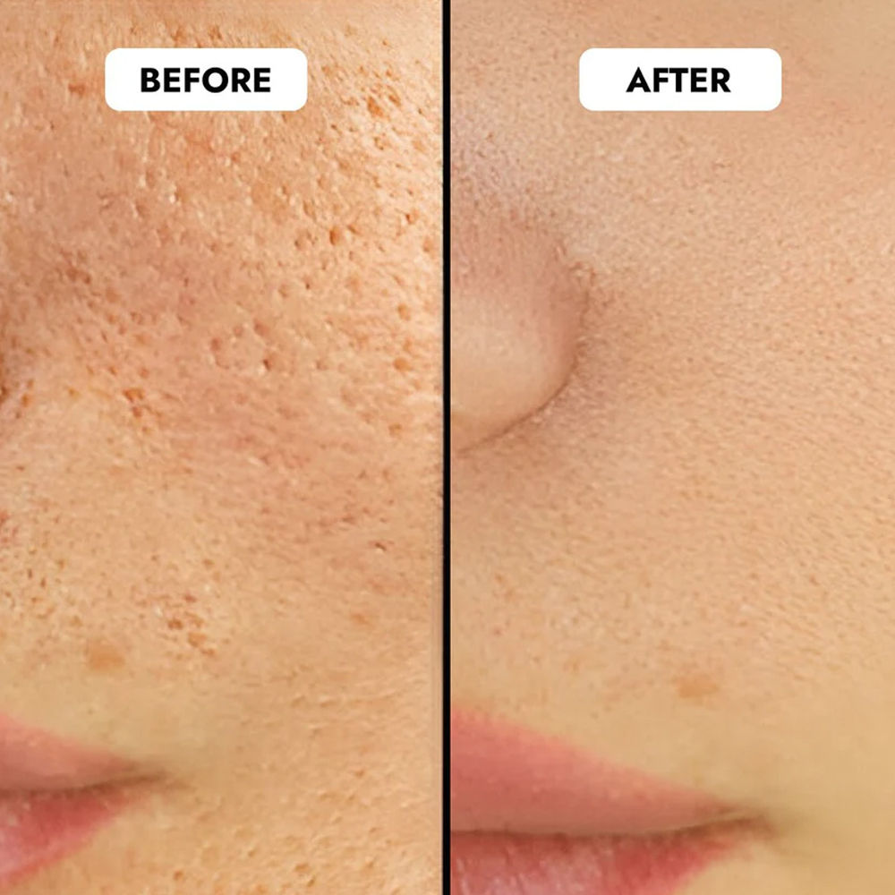 Niacinamide Vitamin B3-5 Face Serum