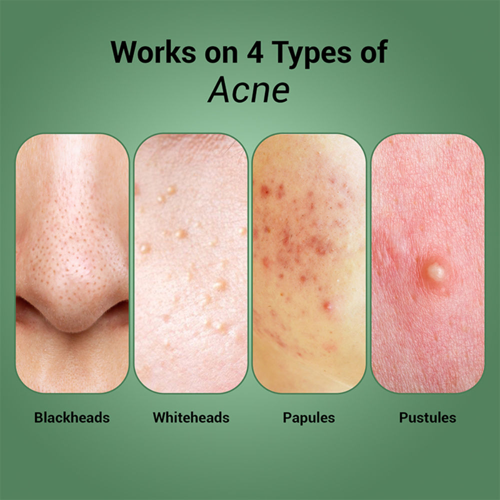 Pore-Clearing Face Wash with 1% Salicylic Acid, 2% Glycolic Acid for Active Acne,Oil Control