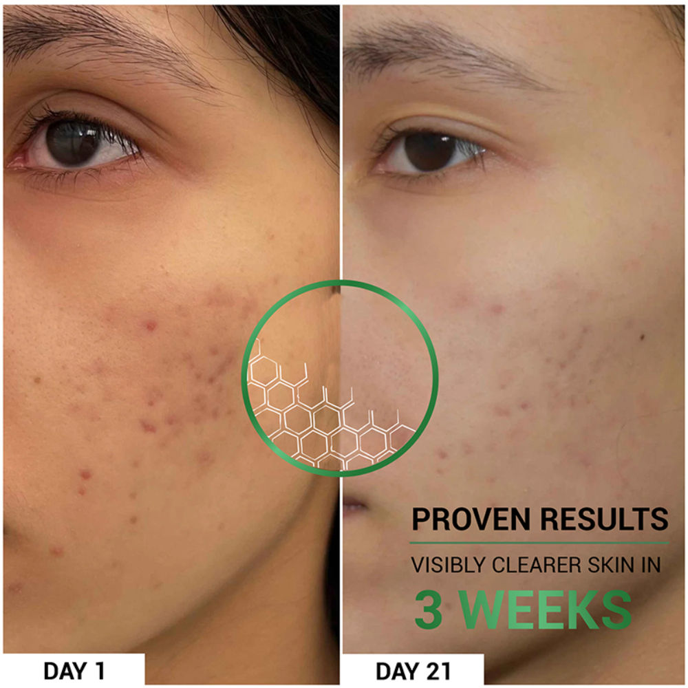 Pore-Clearing Face Wash with 1% Salicylic Acid, 2% Glycolic Acid for Active Acne,Oil Control