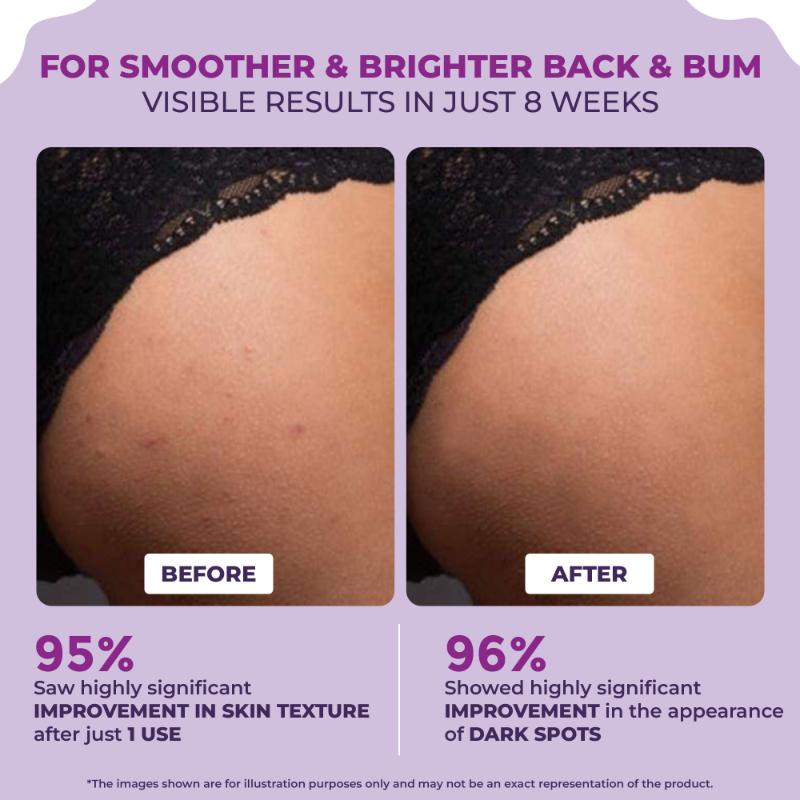Back & Bum Cream For Dark Spots And Body Acne