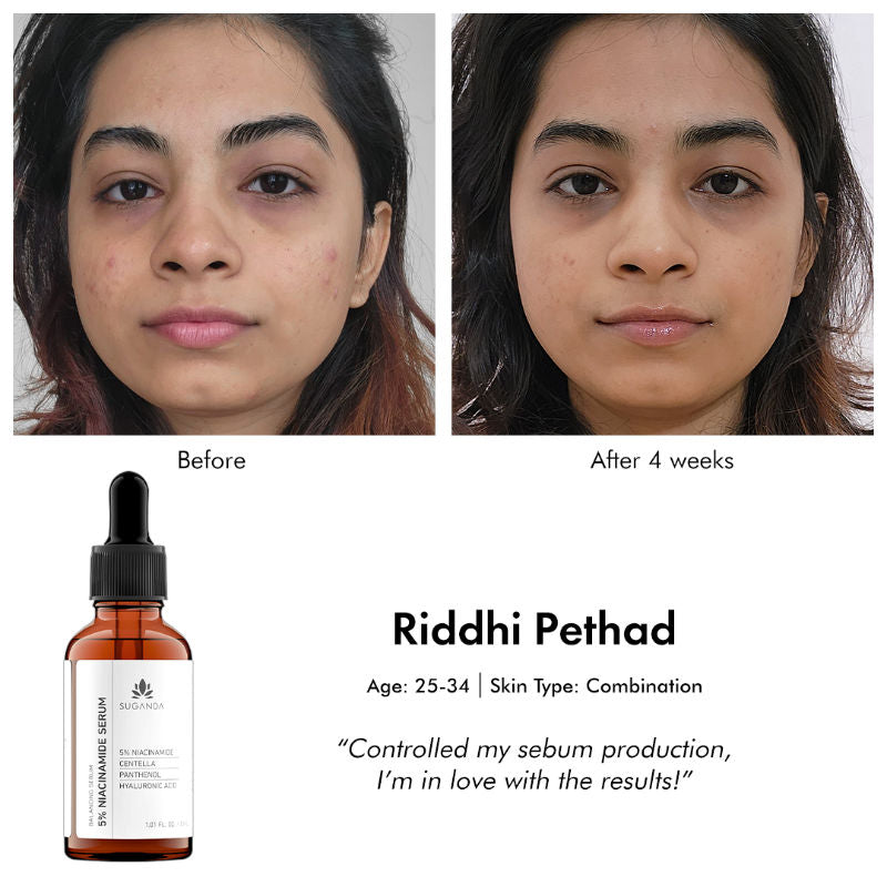 5% Niacinamide Face Serum For Acne & Acne Marks, Blemishes, Pigmentation & Enlarged Pores