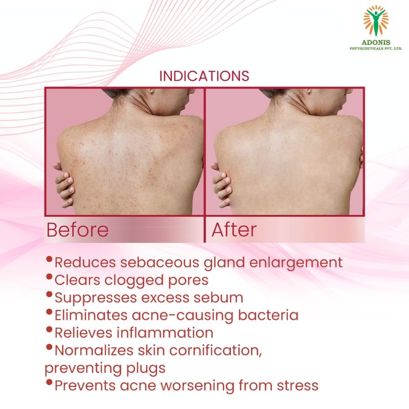 Unisex Kitava Gel Acne treatment gel with Tea Tree & Aloe Vera for Acne Control & Clear Skin