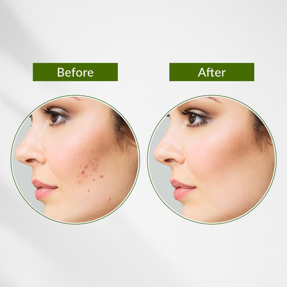 Neem, Tulsi & Salicylic Acid Anti-Acne Purifying Face Gel