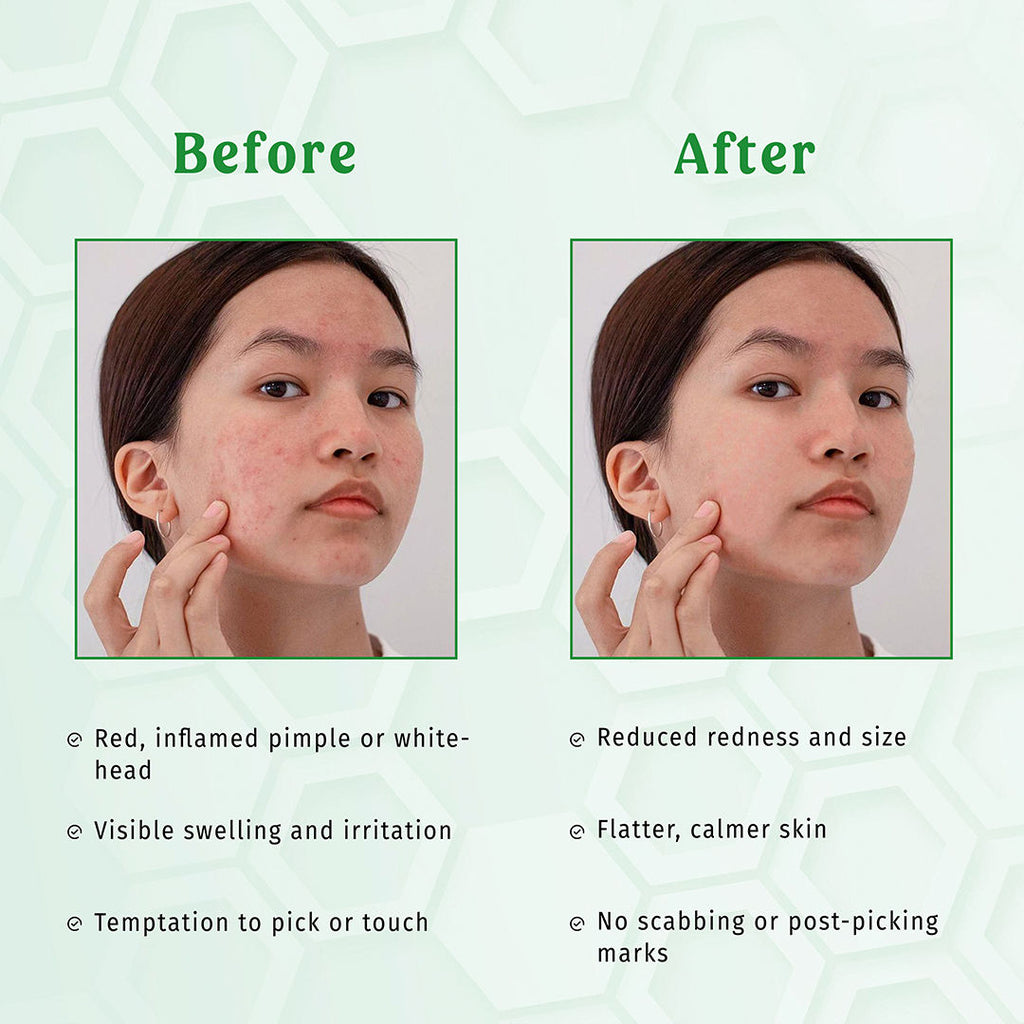 Acne Away Gel Anti Acne Face Gel
