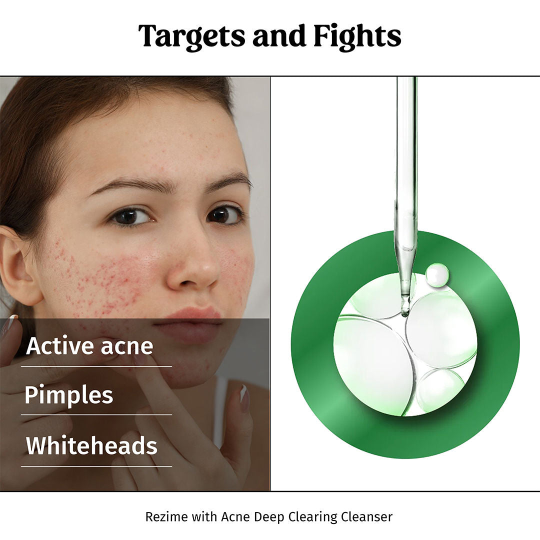 Acne Away Gel Anti Acne Face Gel