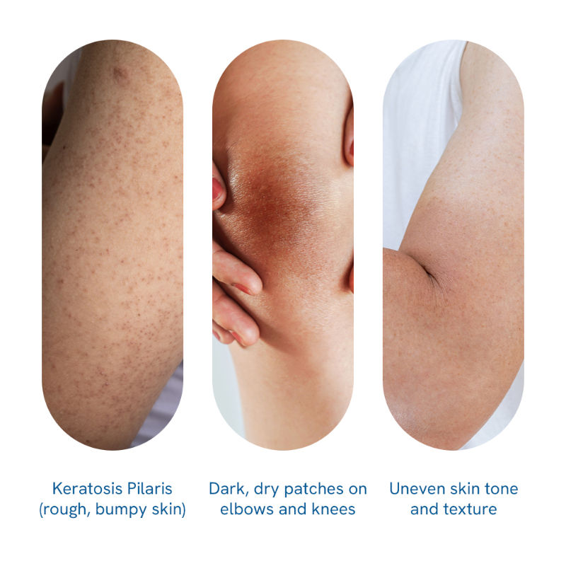 5% Lactic Acid Body Lotion - For 24H Moisturization, Improved Skin Texture, Smooth Skin