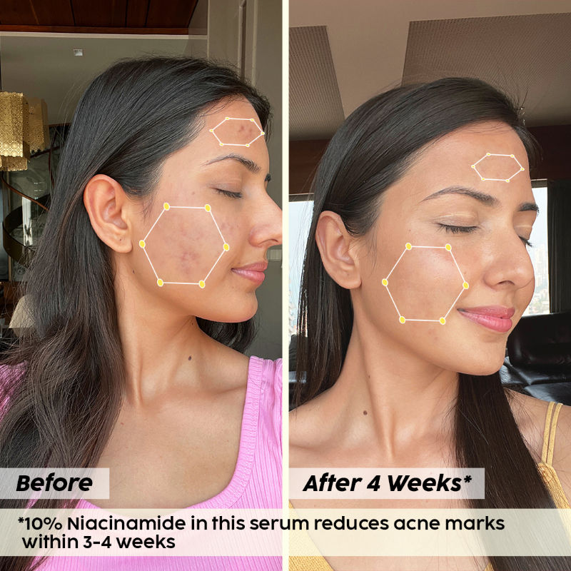 10% Niacinamide Jamun Face Serum for Acne marks, blemishes & oil control