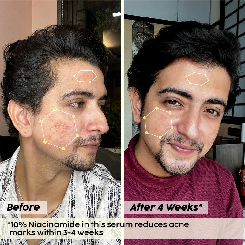10% Niacinamide Jamun Face Serum for Acne marks, blemishes & oil control