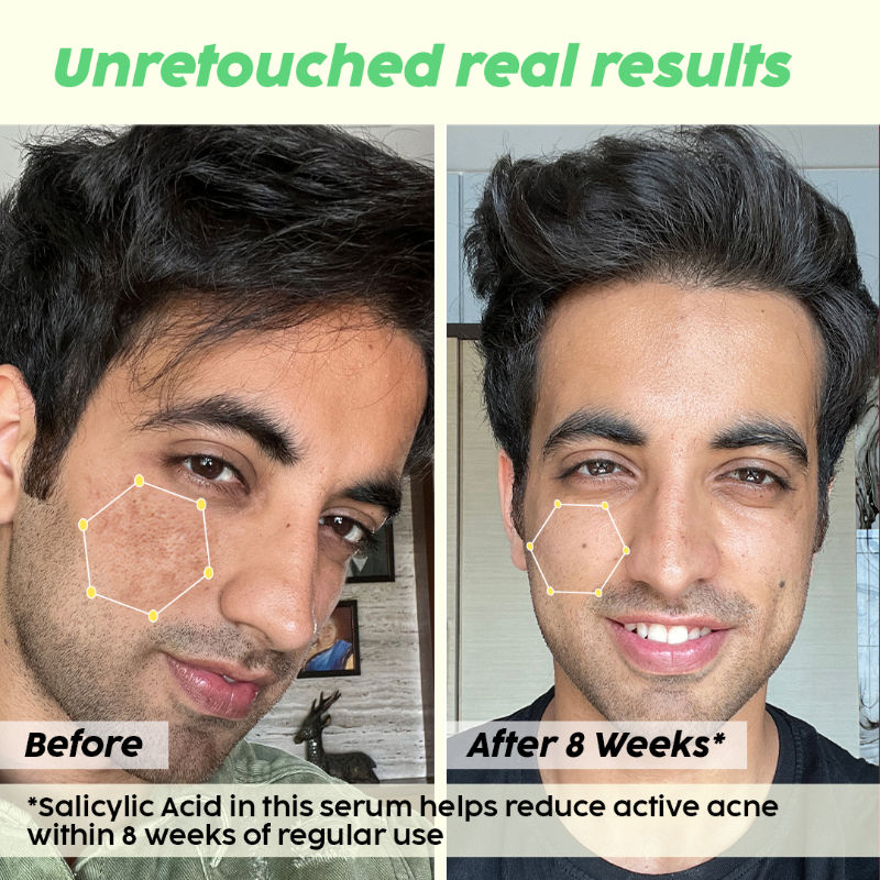 2% Salicylic Acid Jamun Active Acne Control Dewy Serum for Active Acne & Dark Spot Reduction